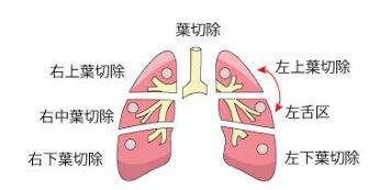中村獅童 肺腺癌ステージ1Aで現在は良くても、油断大敵！再発の可能性が高いだけに、しっかりと予防をしてほしい！