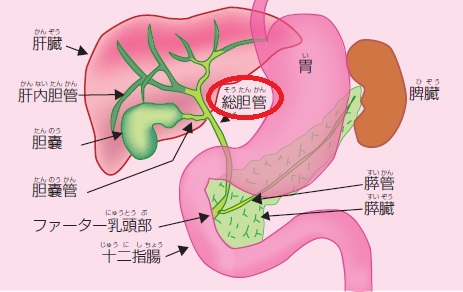 胆嚢摘出手術後にやってはいけないこと