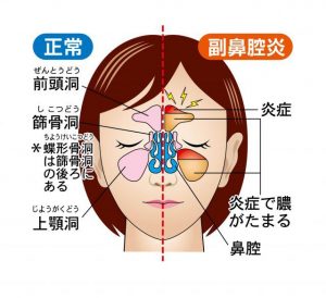 菜々緒 鼻の奥の痛みの原因は副鼻腔炎（蓄膿症）か？病名が明らかにならないため、心配になるが・・・